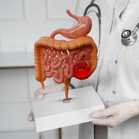 Modelo anatômico centralizado de alta resolução do intestino grosso e delgado mostrando um pólipo ou tumor vermelho brilhante no cólon descendente, segurado por um médico.